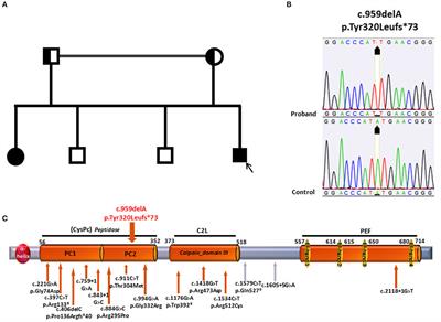 A Novel CAPN1 Mutation Causes a Pure Hereditary Spastic Paraplegia in an Italian Family